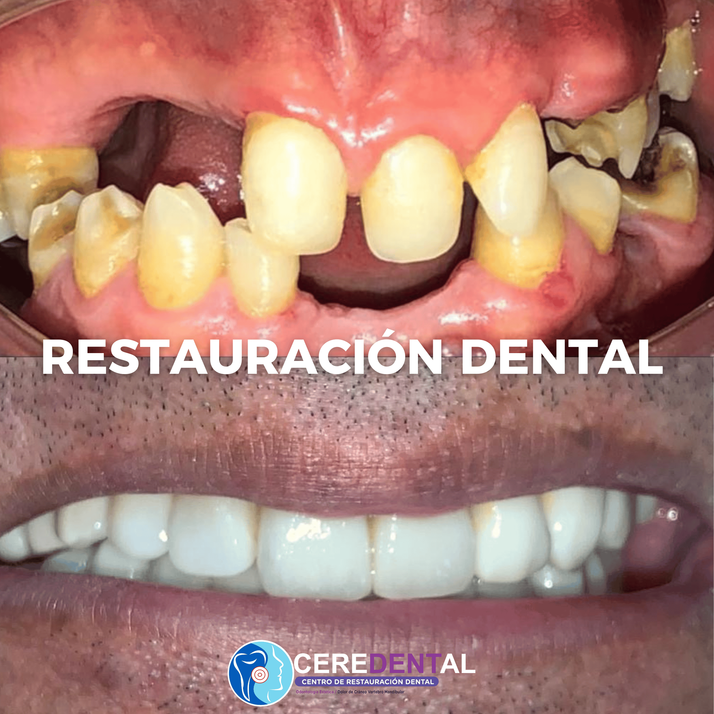 Implantes Dentales - Solución avanzada para dientes perdidos