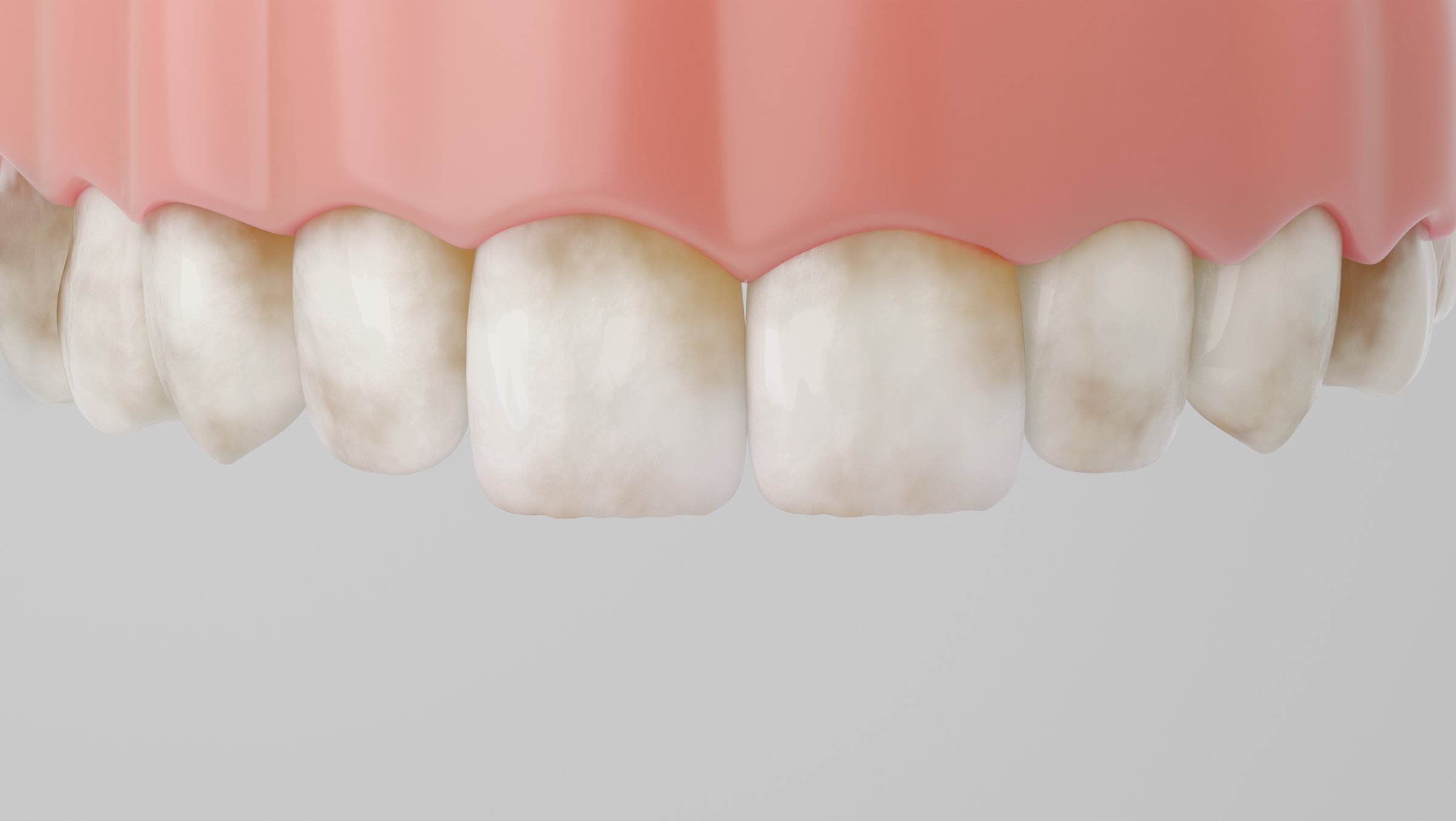 Front teeth with visible Dental Fluorosis stains.
