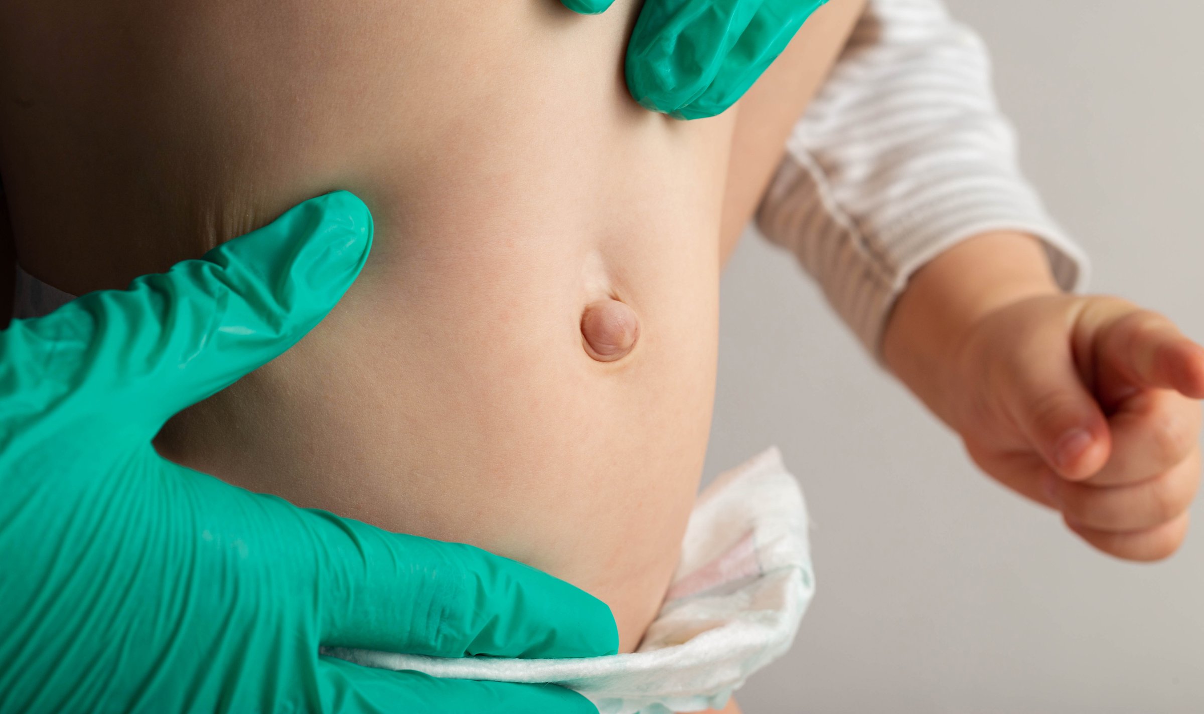 A doctor surgeon in medical gloves examines the abdomen of a newborn baby with an enlarged umbilical ring and an umbilical hernia, close-up.