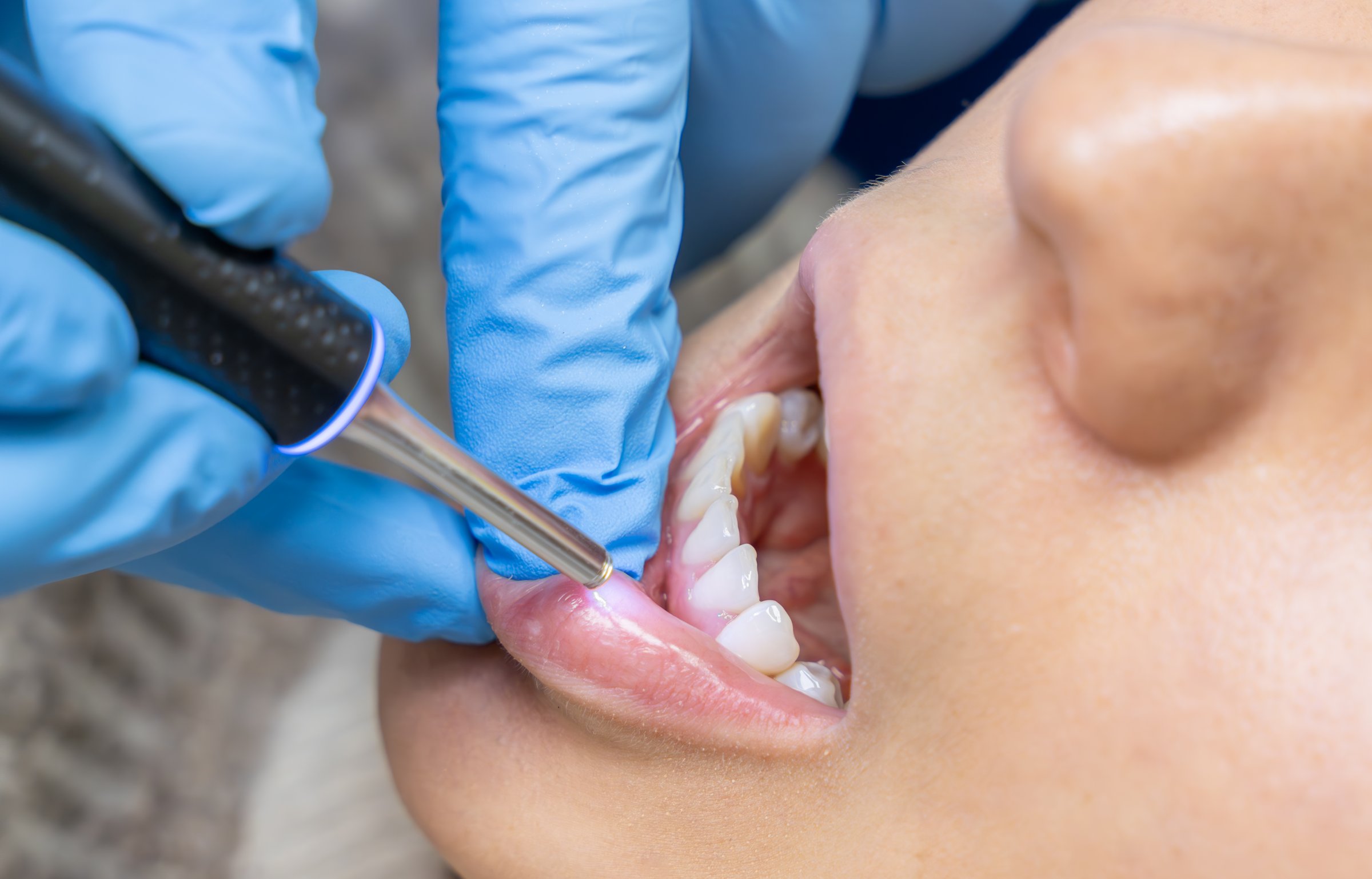 An extreme close-up, macro-style photograph showing a dental procedure inside a patient's open mouth
