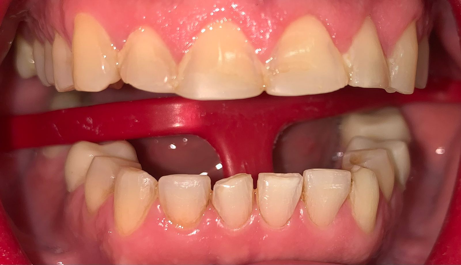 Antes de tratamiento con carillas dentales