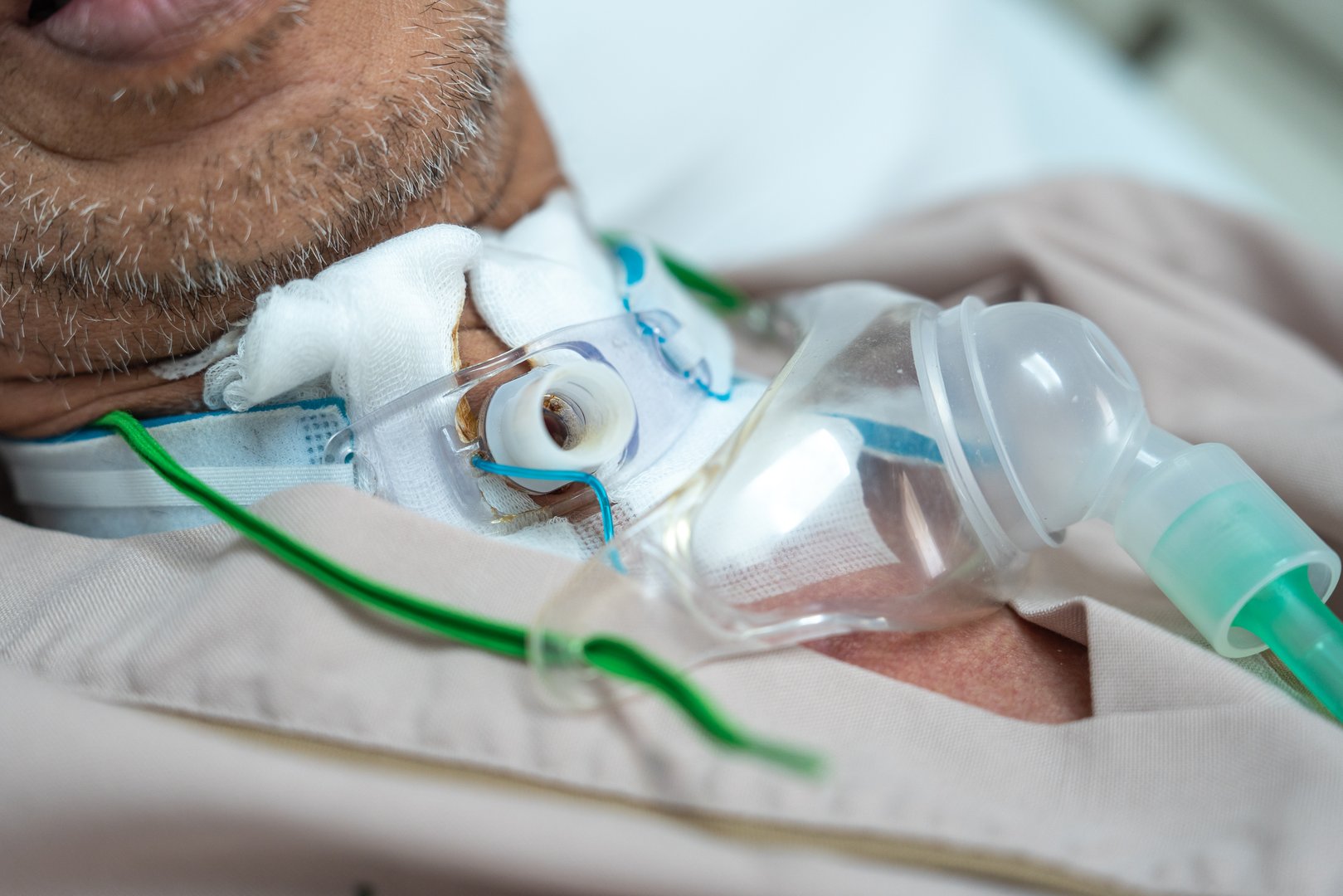 Patients who have undergone a tracheostomy for intubation