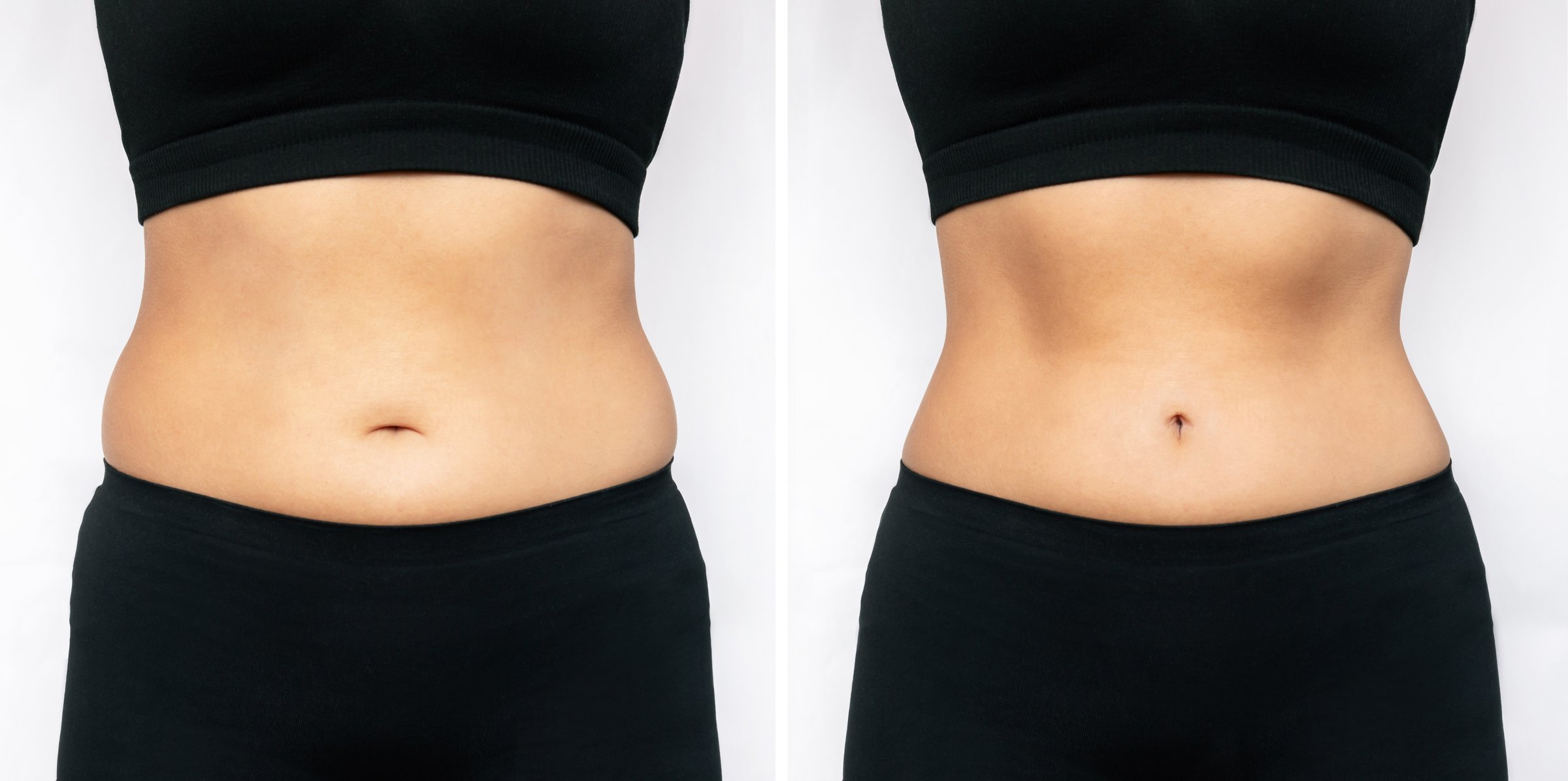Cryolipolyse Before and After Results on Belly and Legs