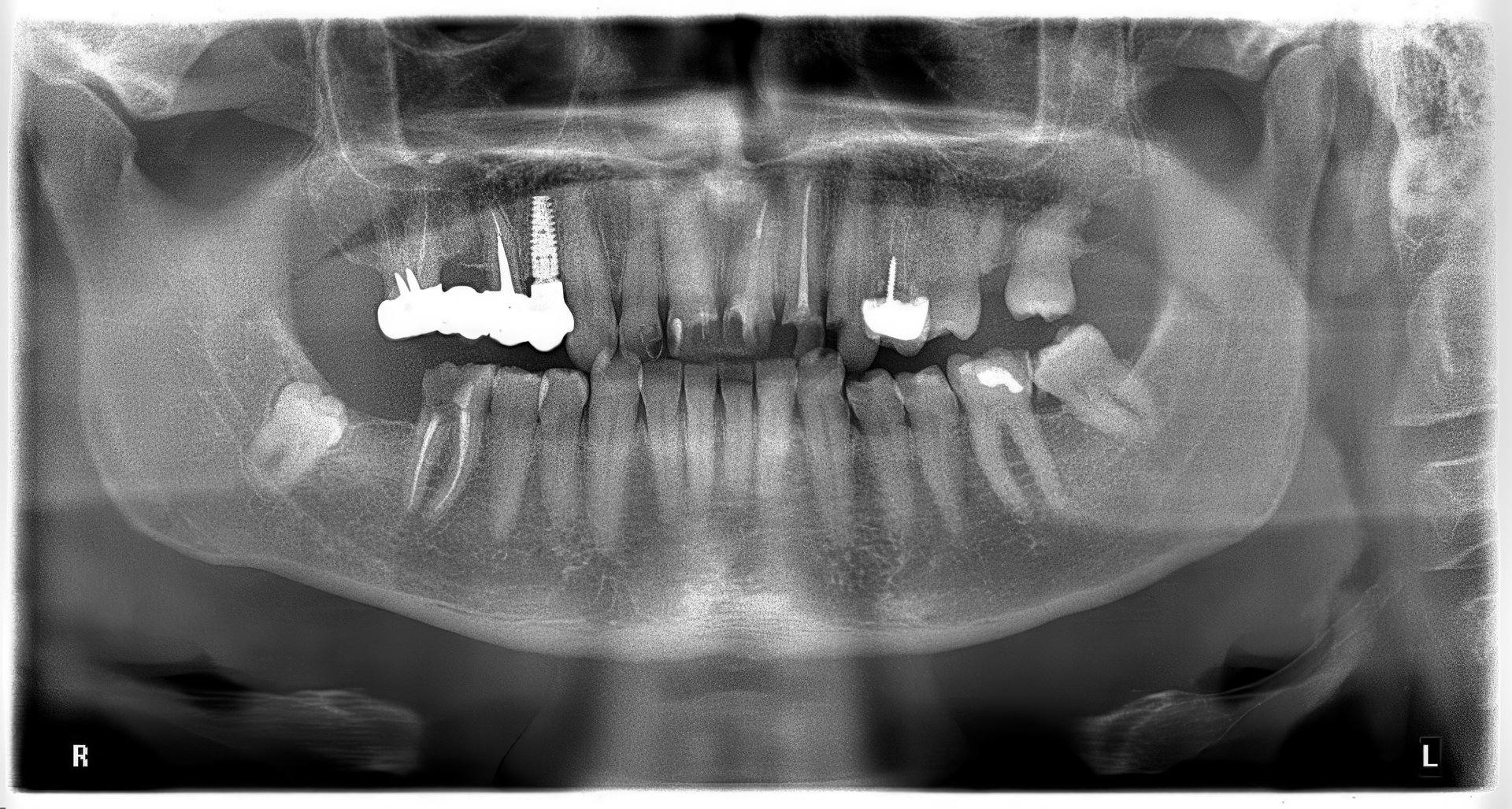 The orthopanotomogram displays a clear panoramic view of the jaw, highlighting dental implants and overall tooth alignment. This scan aids in dental diagnosis.