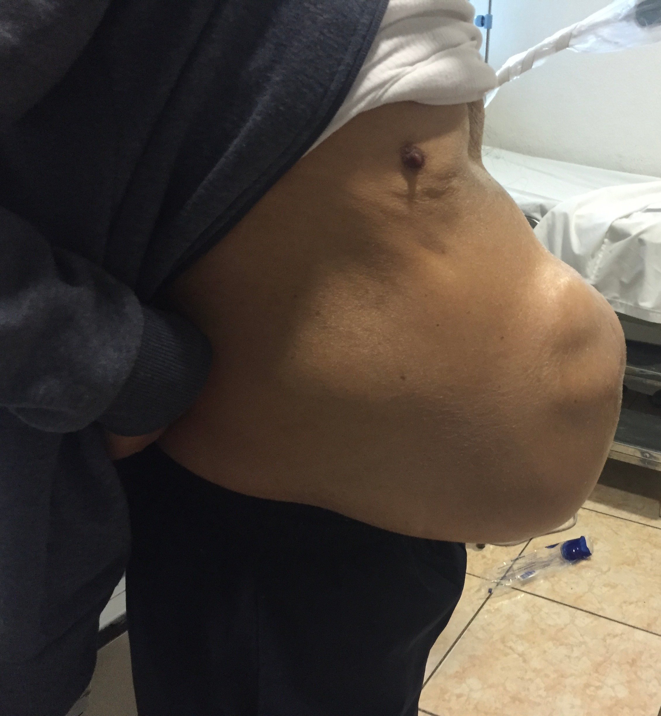 Hernia compleja de pared abdominal