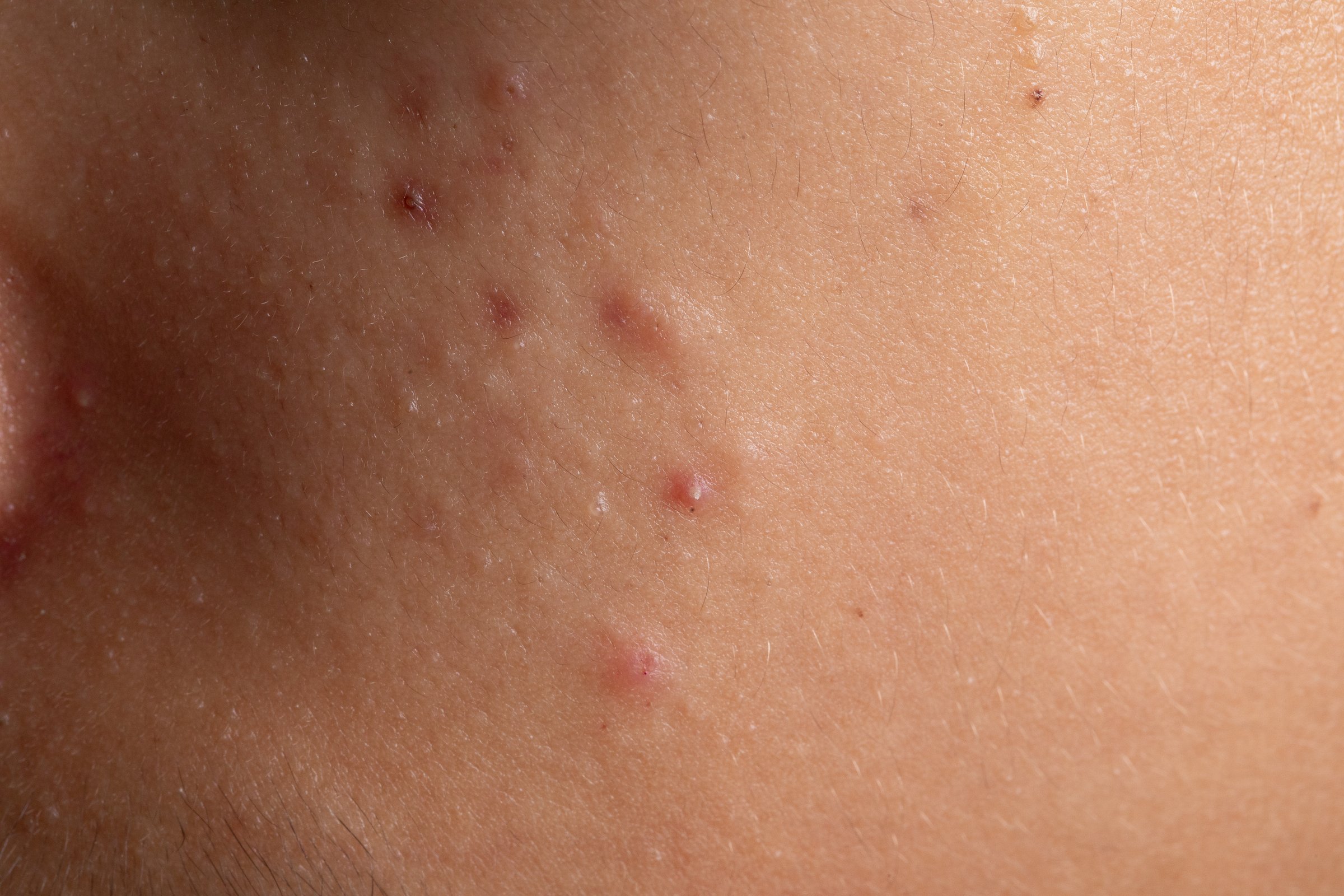 Close-up of inflamed acne and pimples showing skin problems