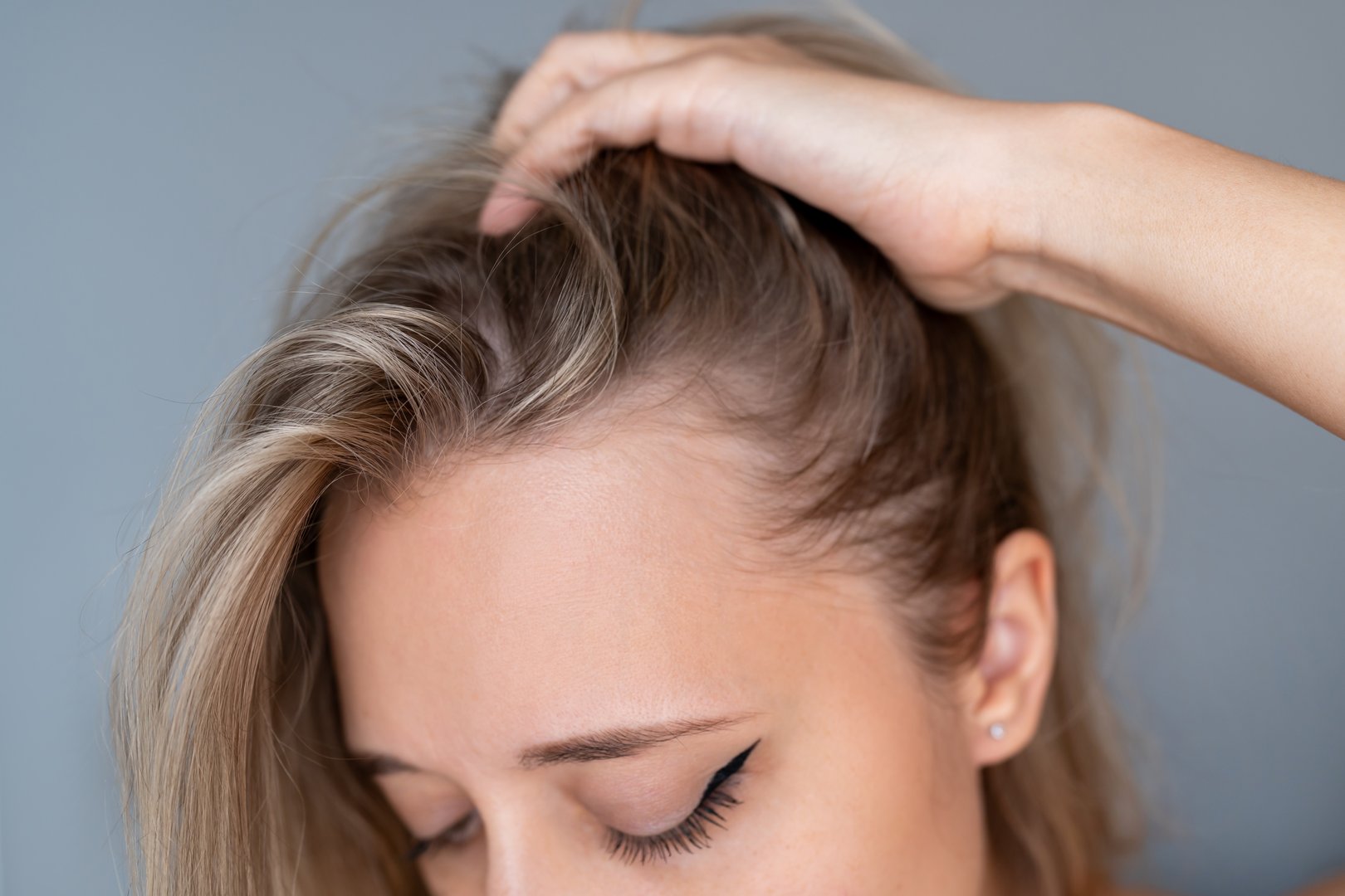 Woman experiencing hair loss and thinning hairline in Bradenton FL - female alopecia treatment consultation at CC Styling Studio SMP specialist