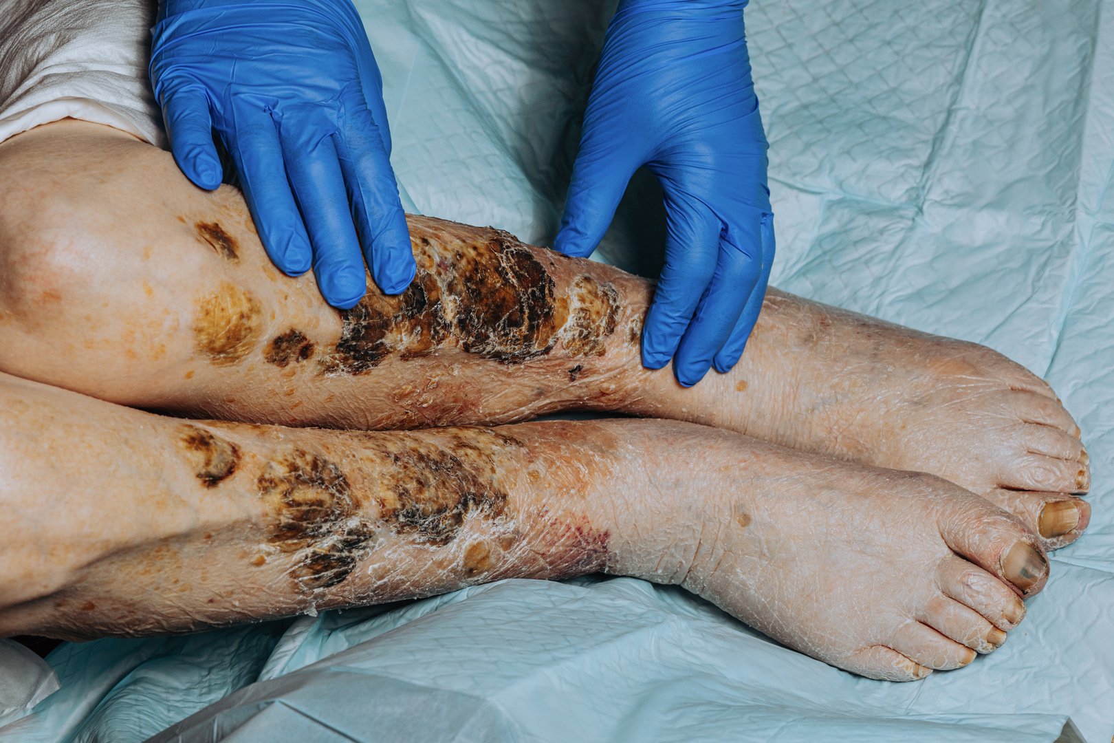 On the legs of an elderly woman, the skin peels off due to eczema, swelling of the legs. Yellowing of the nail plate. Swelling of the legs. Consequences of diabetes in the elderly. Elderly care