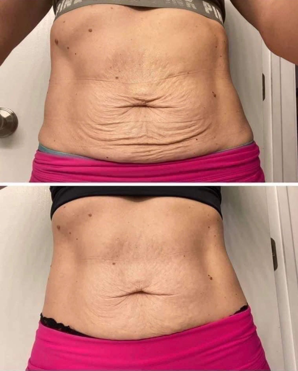 Stretch marks before and after treatment