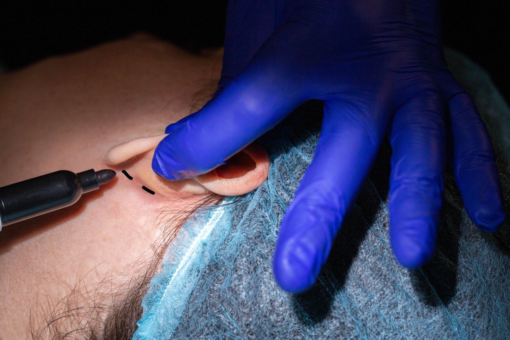 Otoplasty Ear Reshaping Surgery