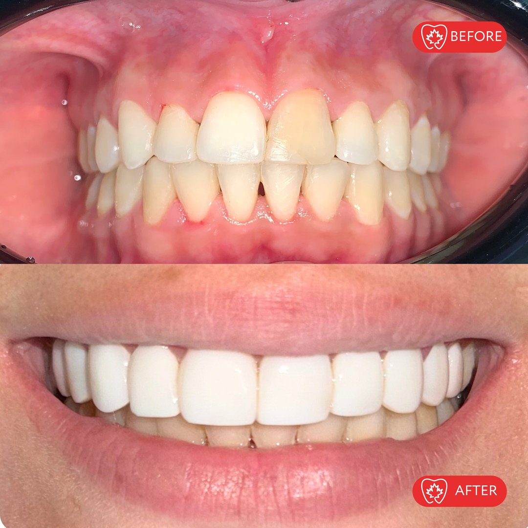 Restauración dental - Caso