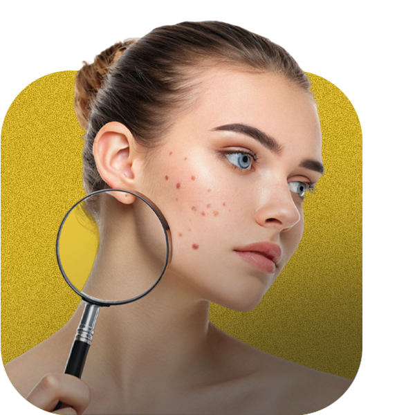 Acne care diagnosis