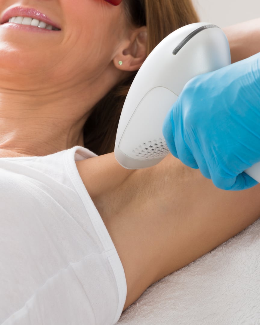 Laser hair removal treatment