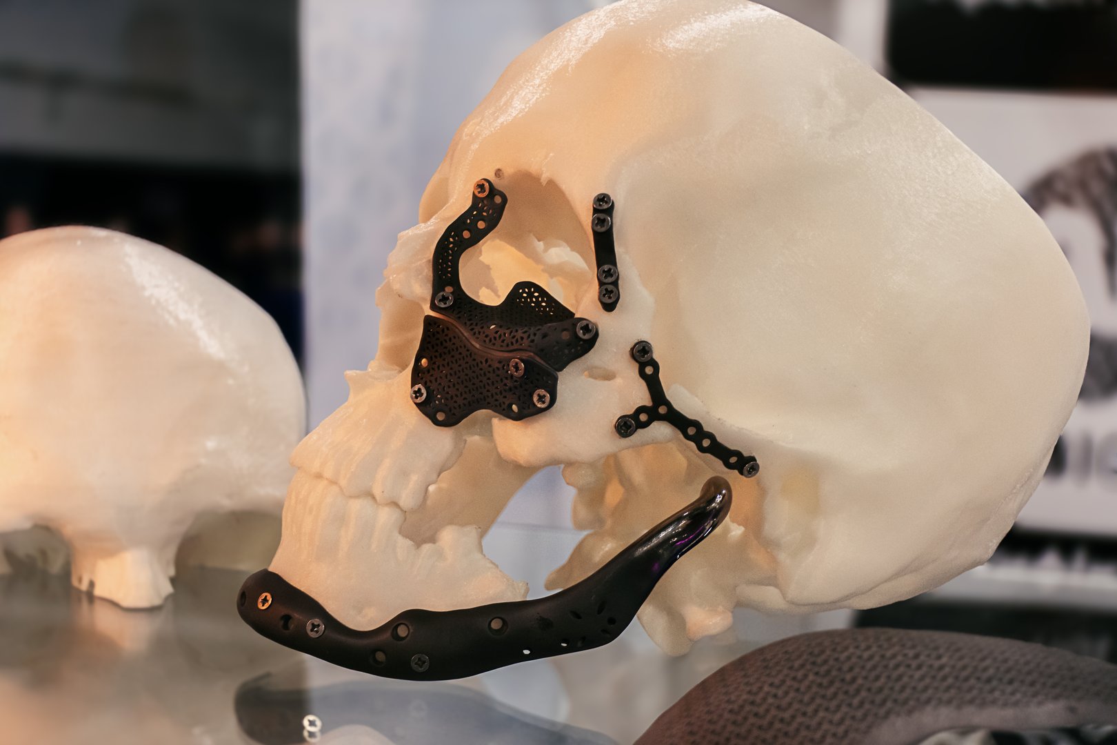 Orthopedic implants and individual titanium cranioplasties printed on a 3D printer