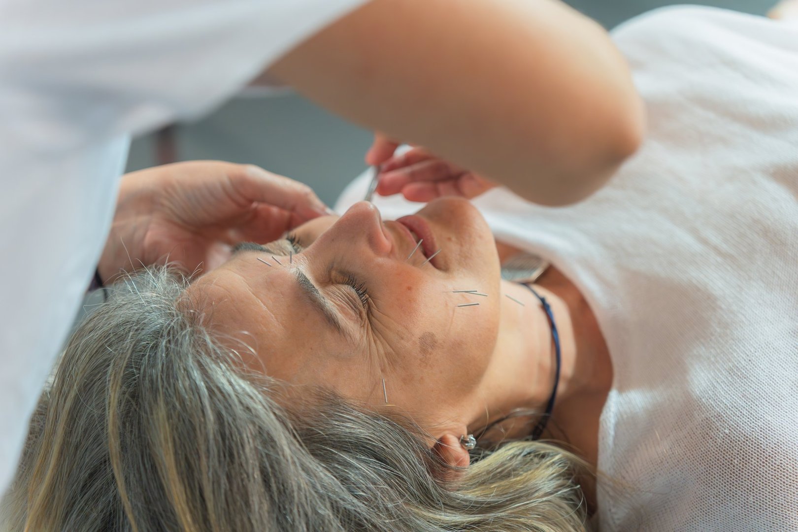 Close-up of facial acupuncture treatment to an elderly woman. Alternative medicine concept.