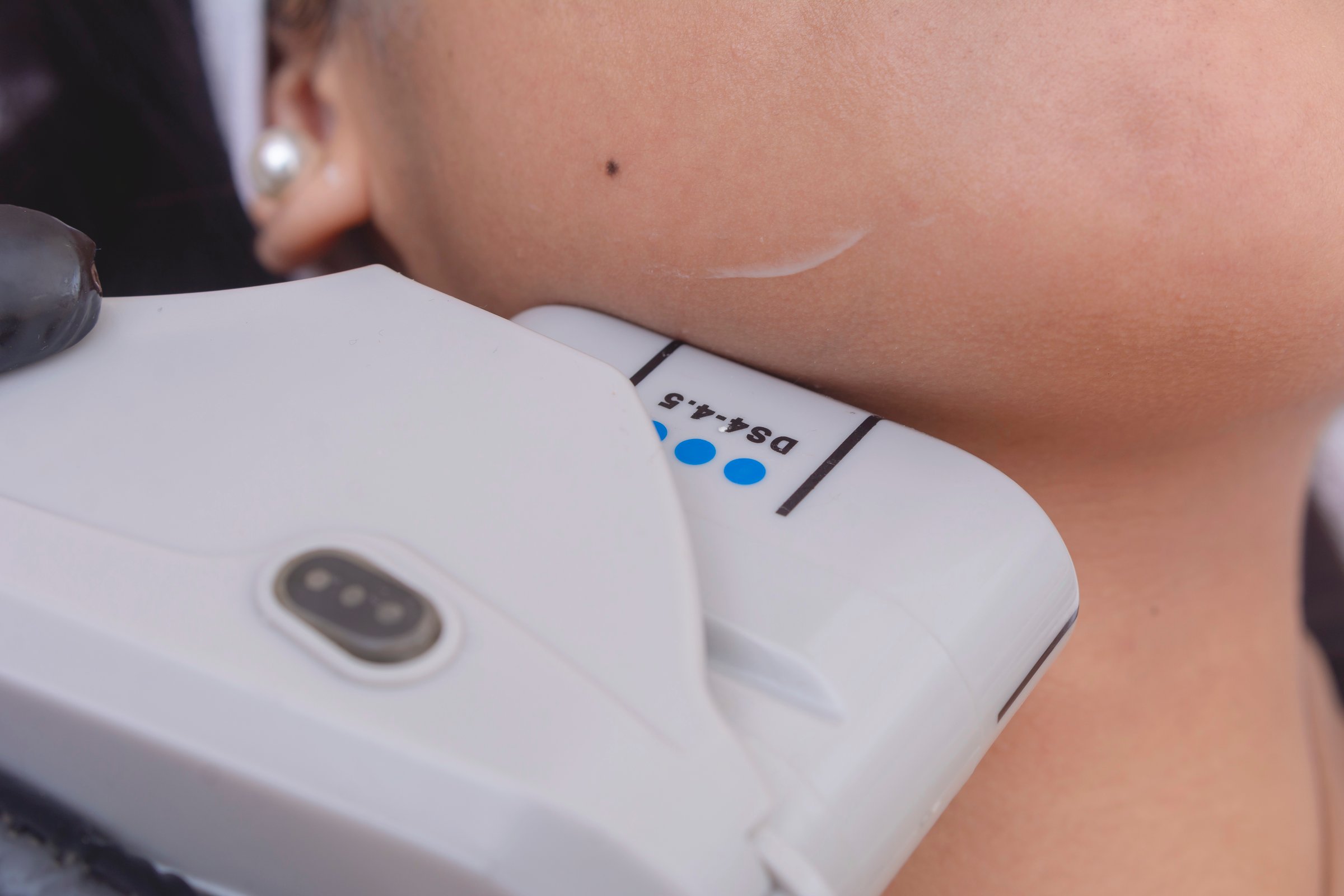 Closeup of HIFU treatment on a woman's jawline. High Intensity Focused Ultrasound technology. At a skin care, dermatologist or aesthetic clinic.