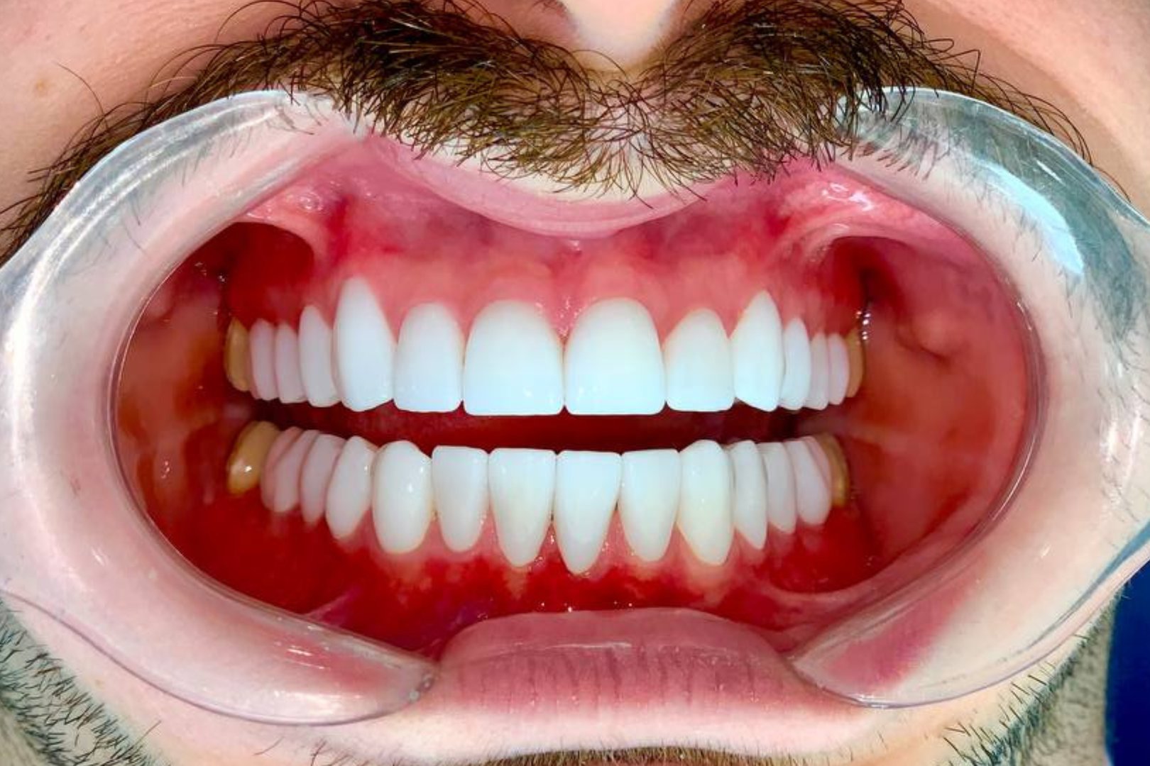 Transformación de blanqueamiento dental