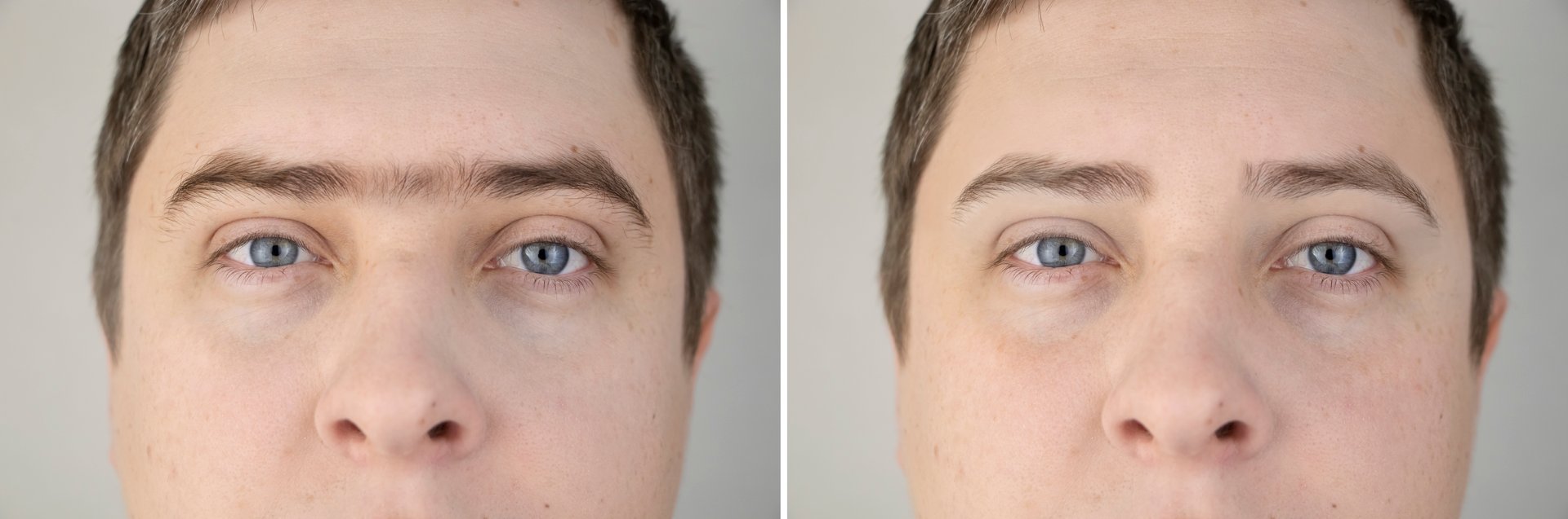 Fused eyebrows and sinofreeze in men. Photo before and after modeling eyebrows in a guy. Male self-care and a visit to a beautician or foreman