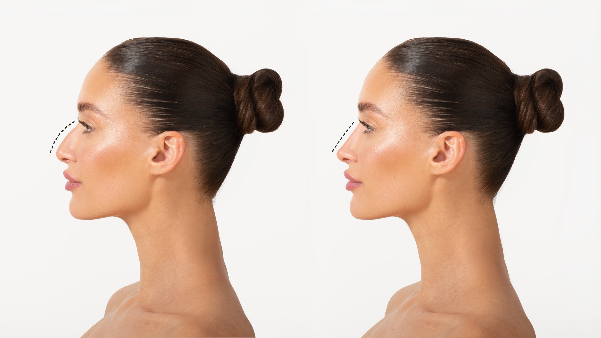 Rhinoplasty before and after. Comparison of female nose after plastic surgery, woman standing isolated on white background, side view