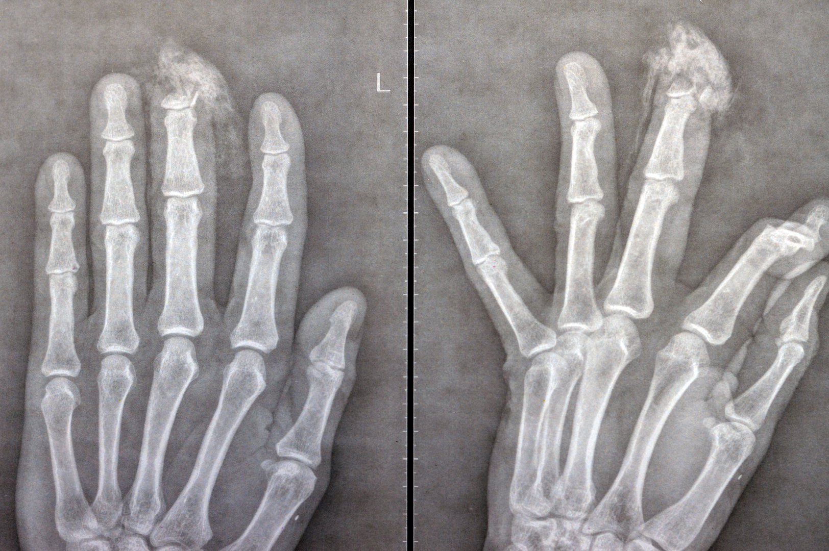 Plain X-Ray reveals distal tip amputation of distal phalanx of the middle finger of the left hand of an adult man, caused by a sharp bladed machine and needed surgical intervention and repair