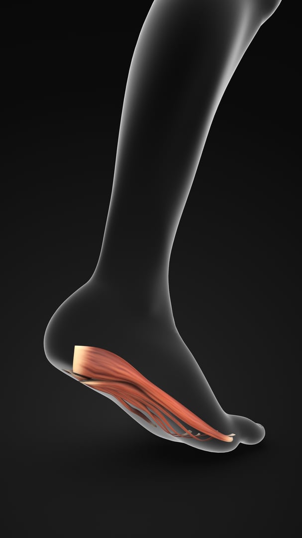Plantar fasciitis is a degenerative condition that causes inflammation of the plantar fascia, a fibrous tissue that runs from the heel to the ball of the foot and toes.
