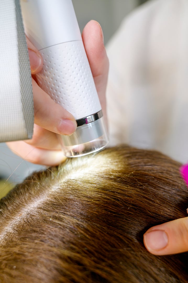 Trichological and dermatological examination of brunette woman's scalp and hair follicles. Trichology concept. Optical instrument, trichoscope, close-up.Trichologist control a head's skin of a patient