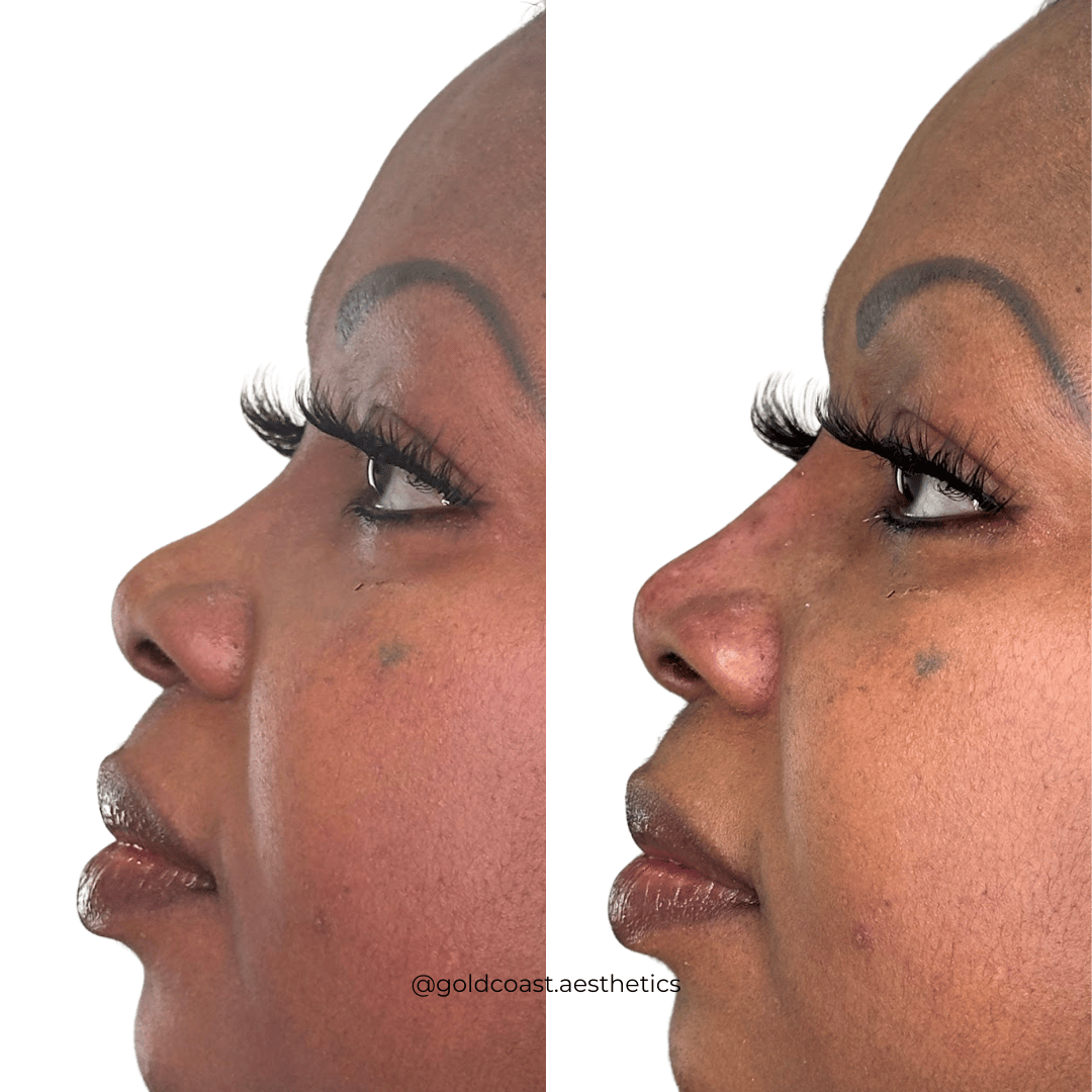 Nose enhancement before and after