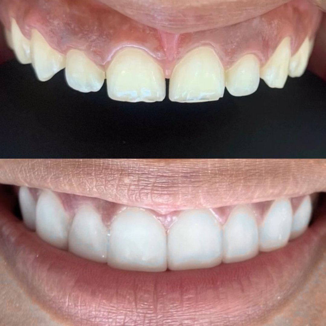 Carillas de Resina en Cancún Tropical Dental