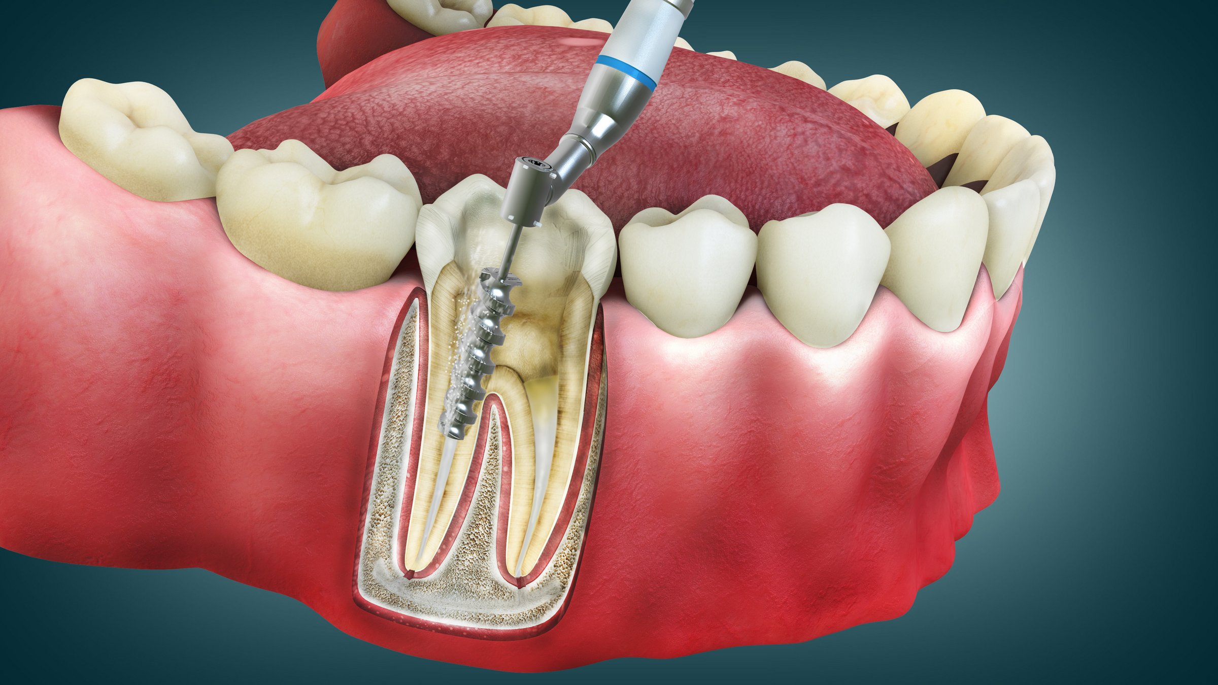 Servicios de Endodoncia