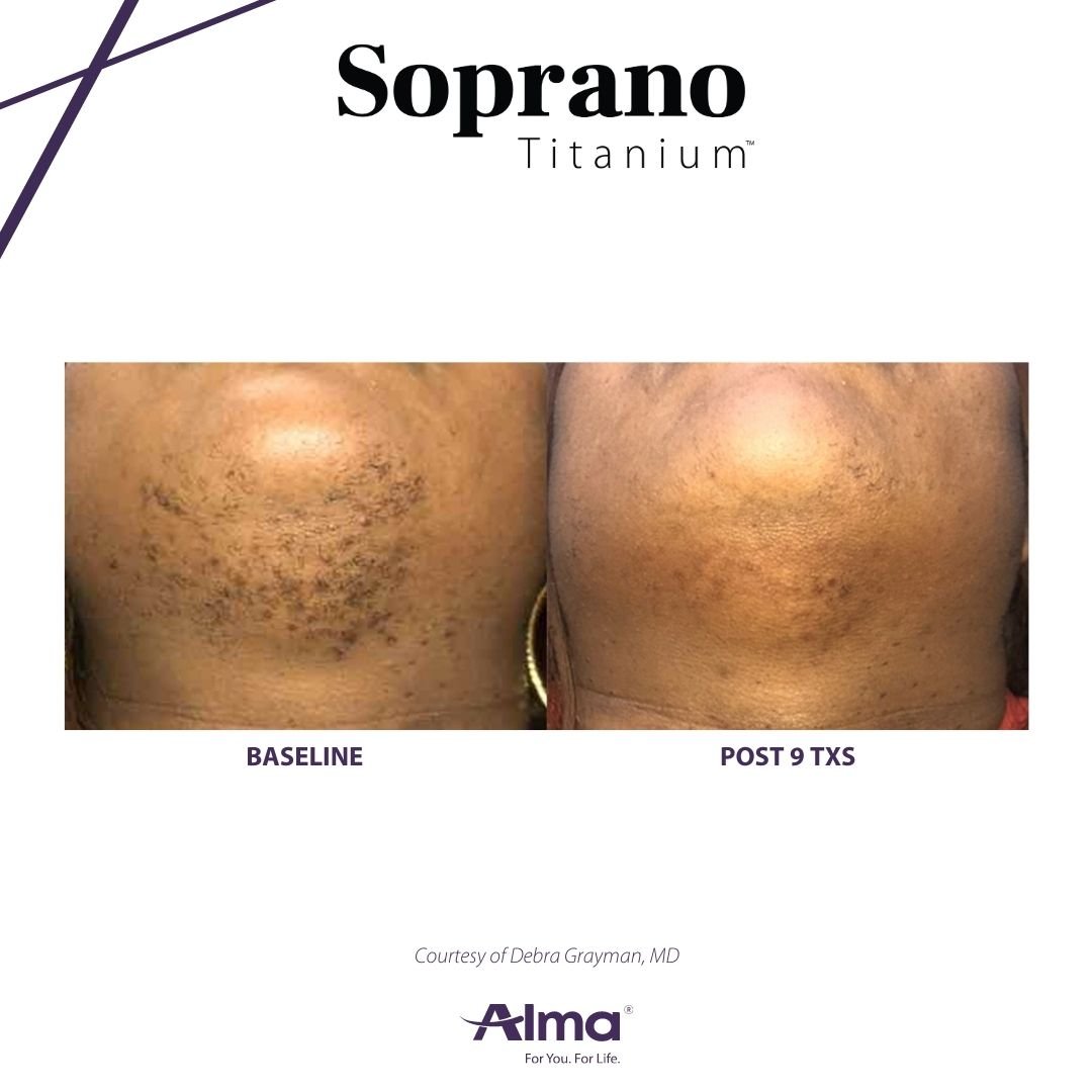 Soprano Titanium before and after treatment results