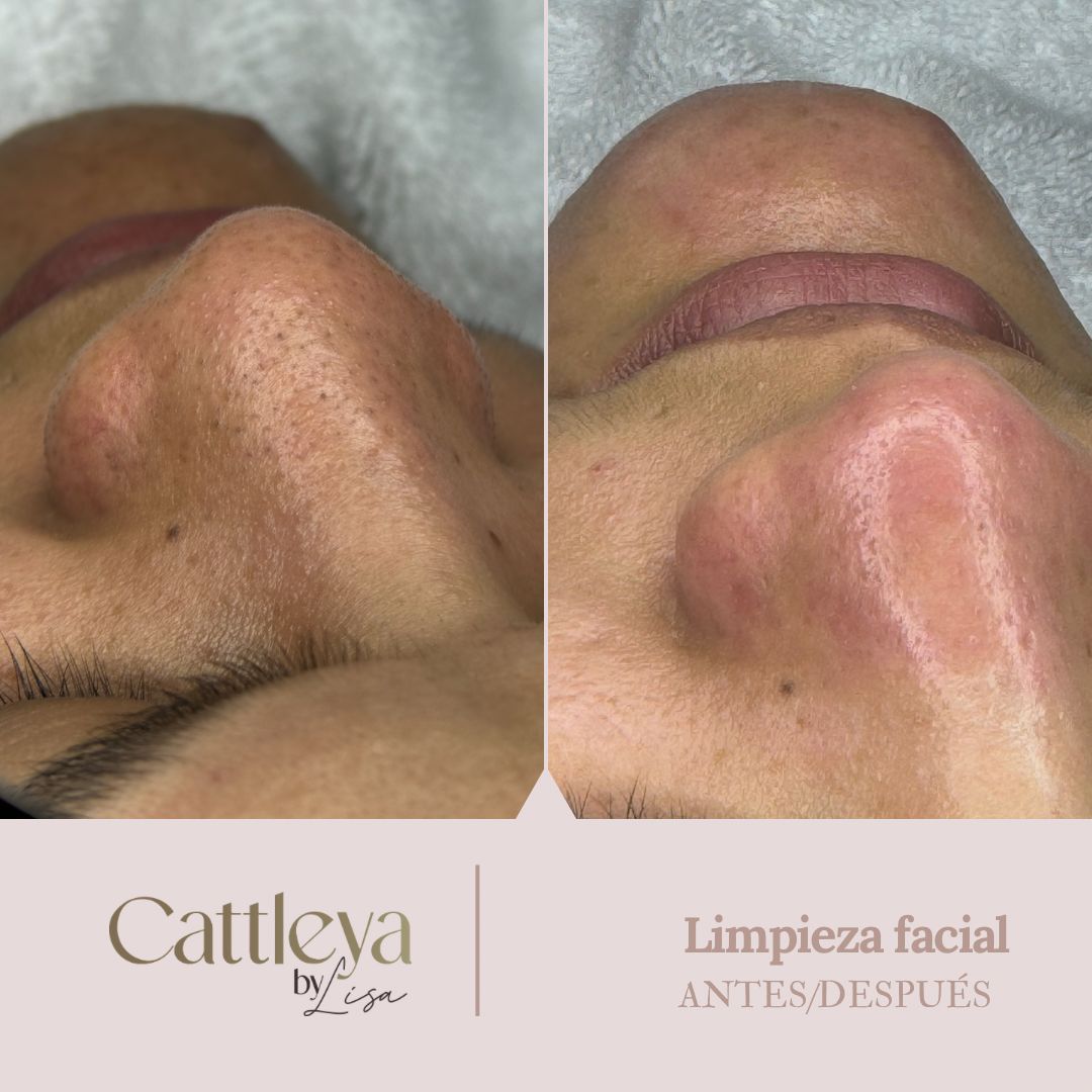 Limpieza facial profesional - Antes y después