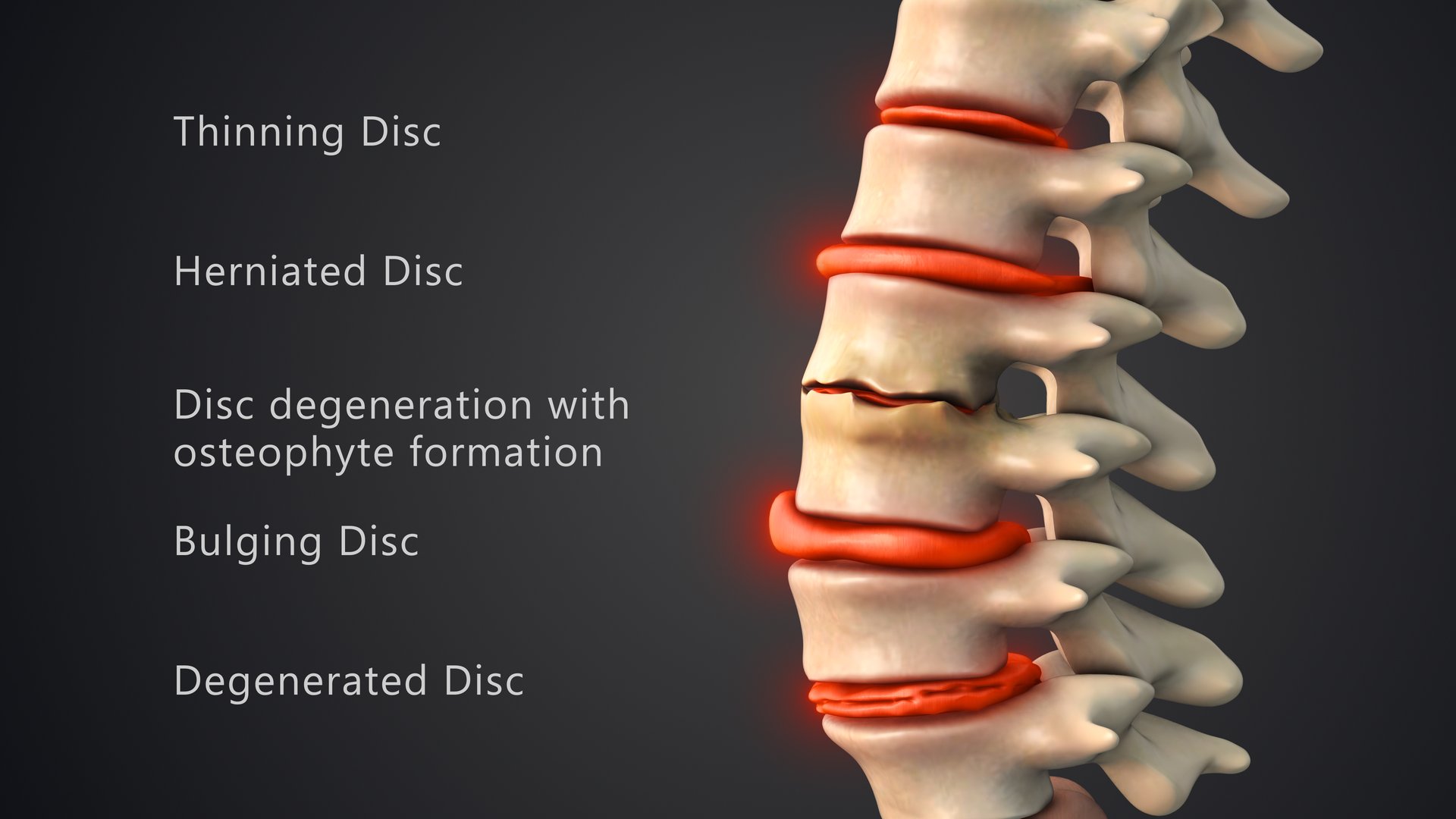 Spinal disc problems can be caused by aging, injury, or everyday activities. The rubbery pads between the vertebrae in the spinal column can swell, tear, or bulge when stressed or injured, which can press on a nerve.