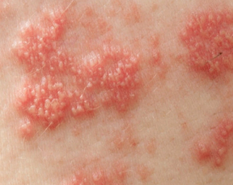 Triệu chứng mụn rộp sinh dục