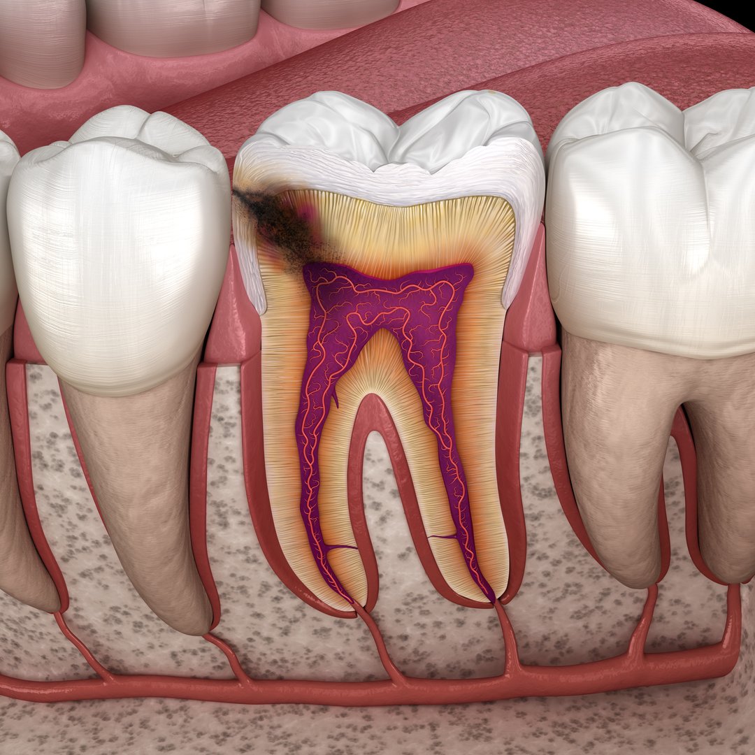 Hidden caries in to molar tooth. Medically accurate 3D illustration