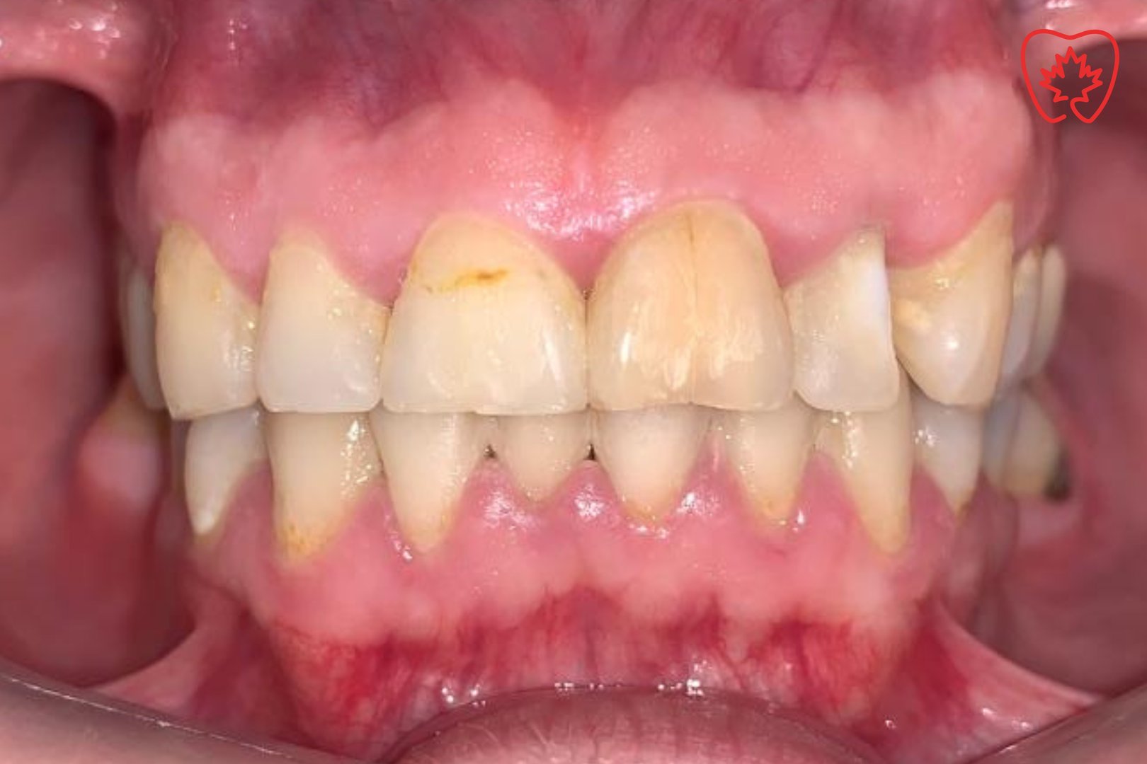 Carillas dentales - Resultado