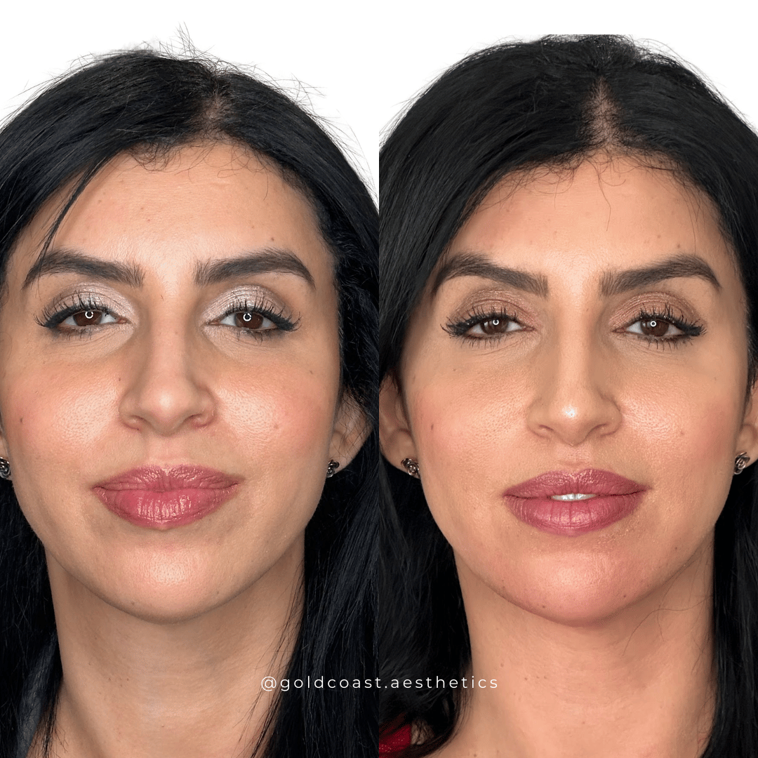 Natural facial enhancement results
