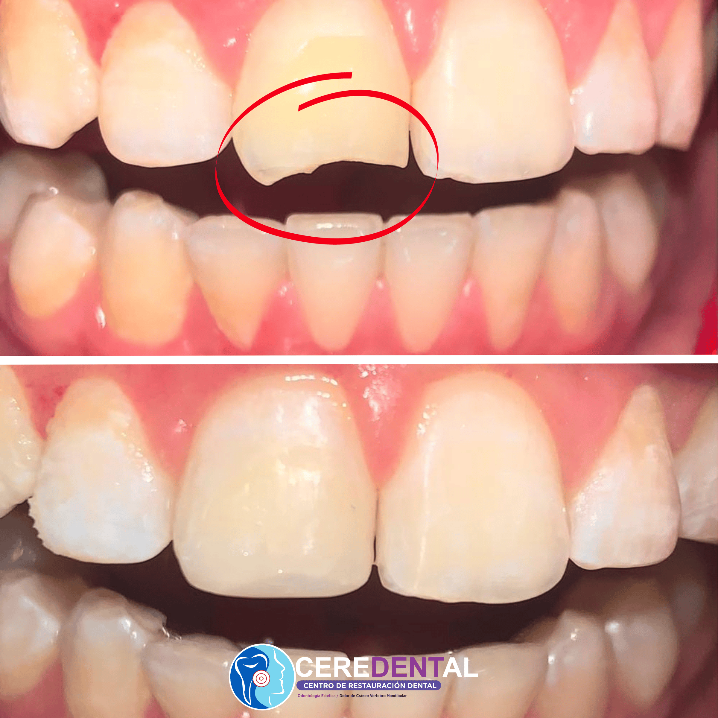 Resinas Dentales - Restauración dental estética