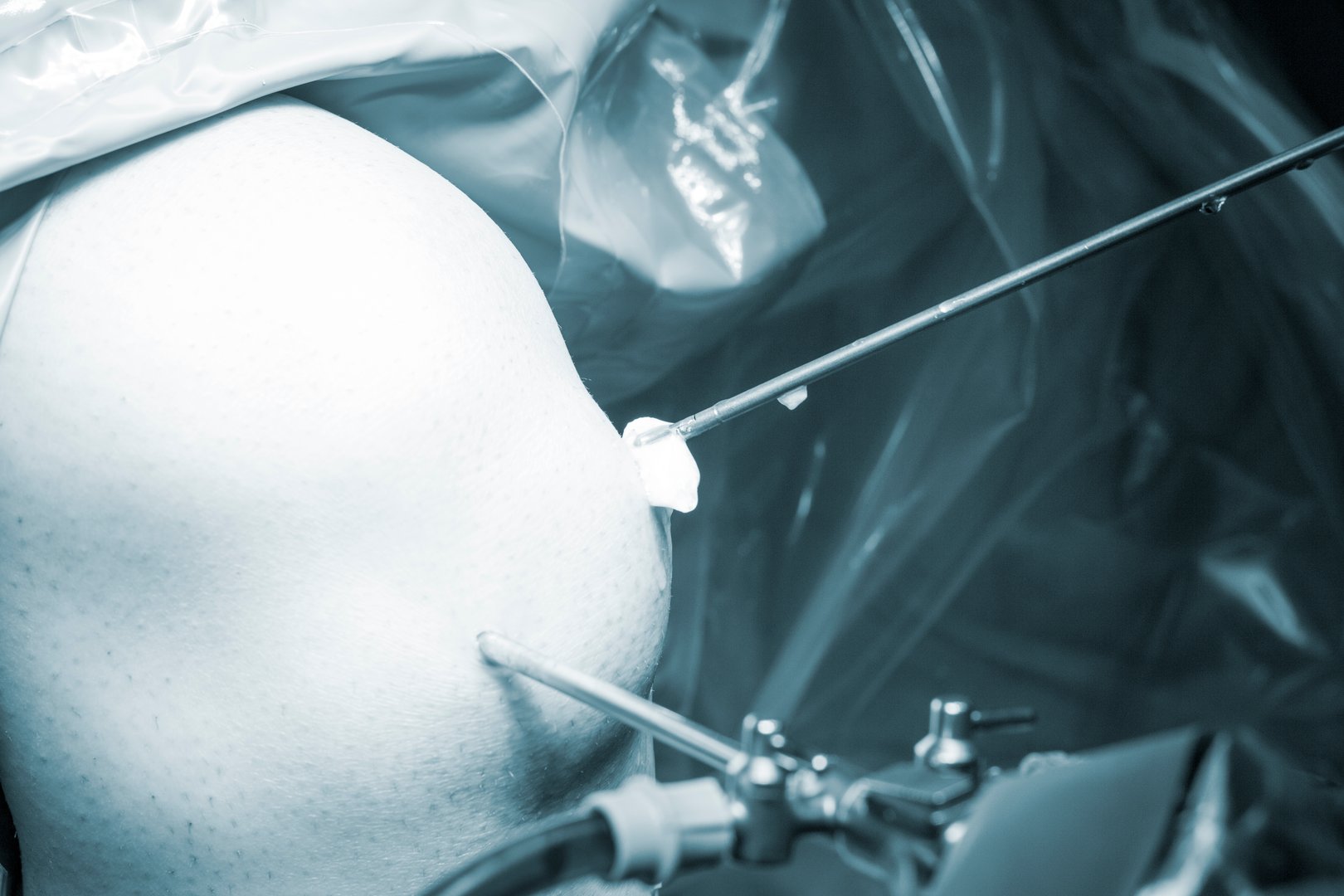 Hip arthroscopy surgery procedure