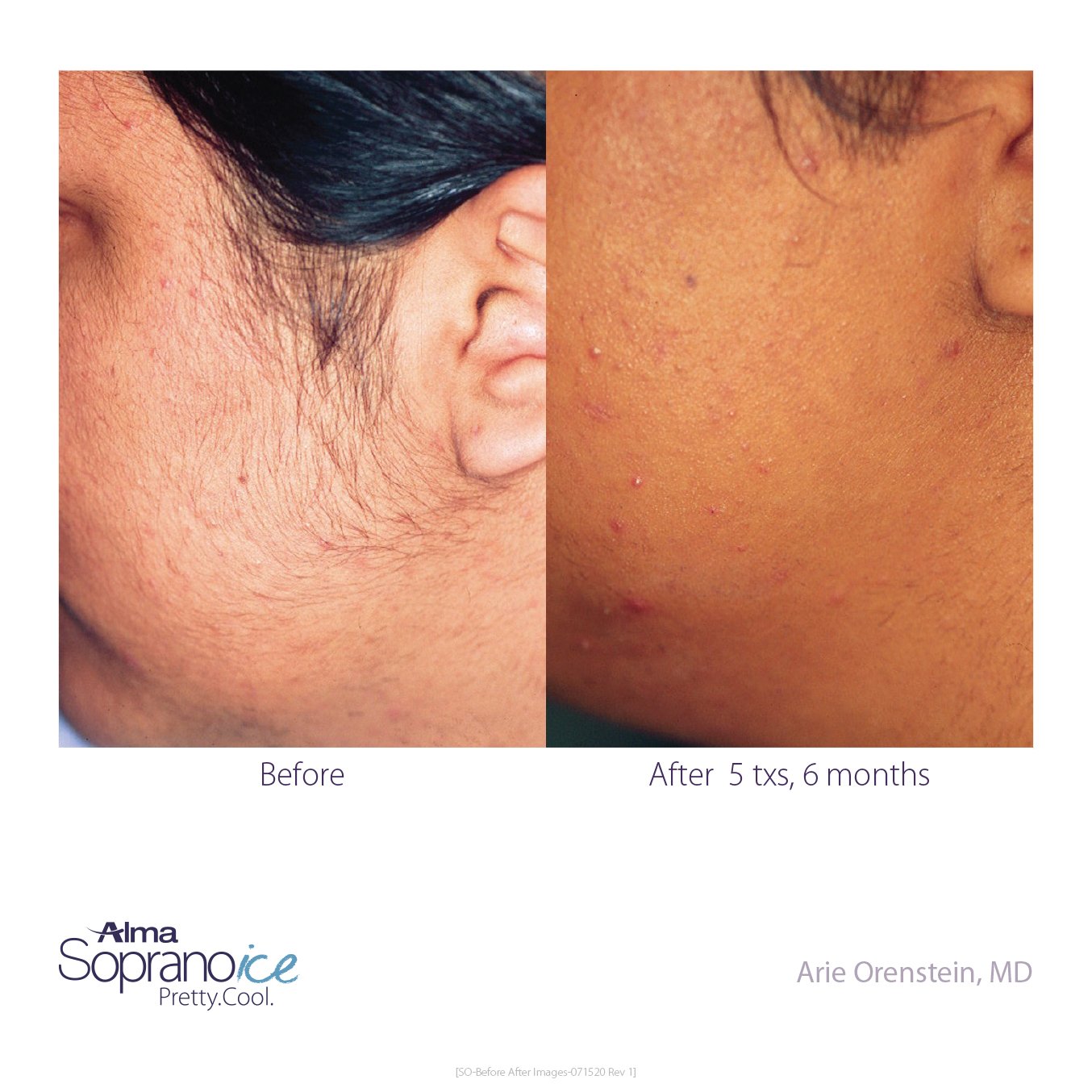 Soprano ICE before and after hair removal results