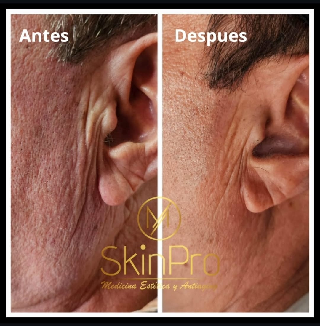 Resultado del tratamiento