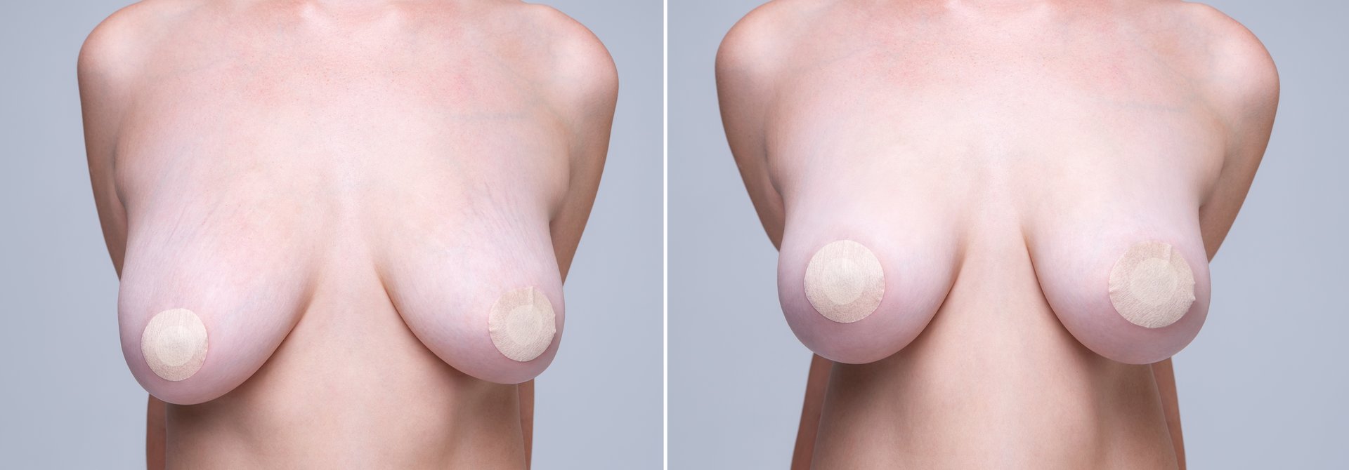 Before and after breast augmentation concept, woman with large silicone breasts after correction surgery on gray background