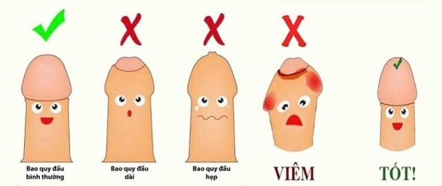 Phân biệt bao quy đầu dài và hẹp