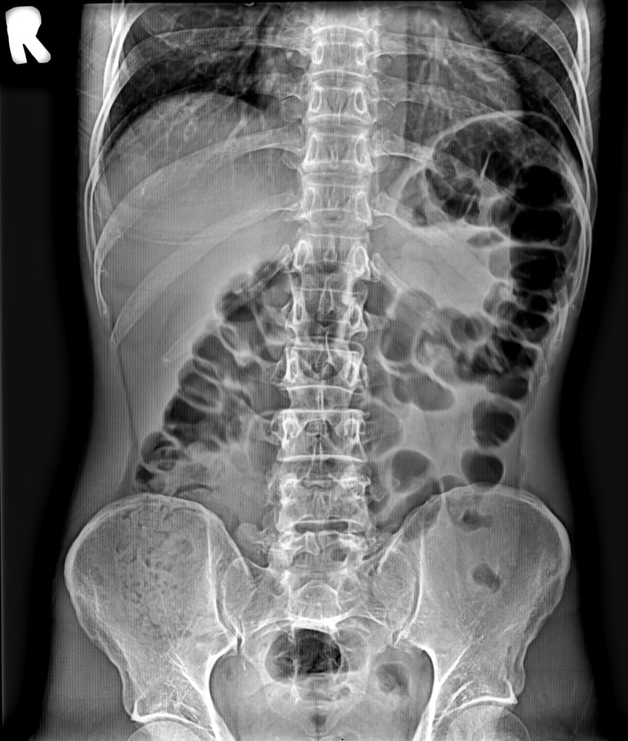 x- ray of the abdomen, spine and pelvis with hip jointss