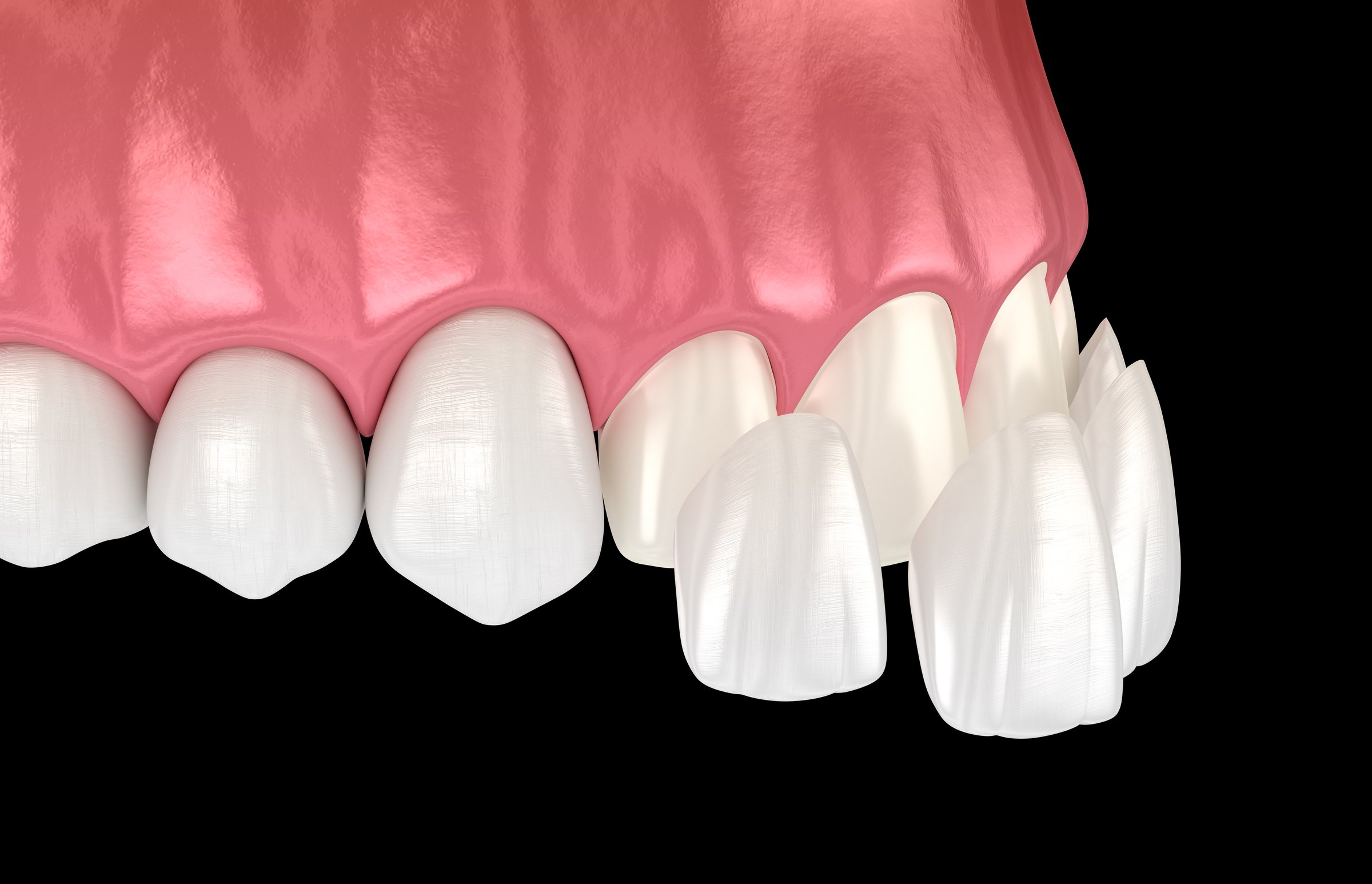 Dental veneer placement over frontal teeth. 3D illustration