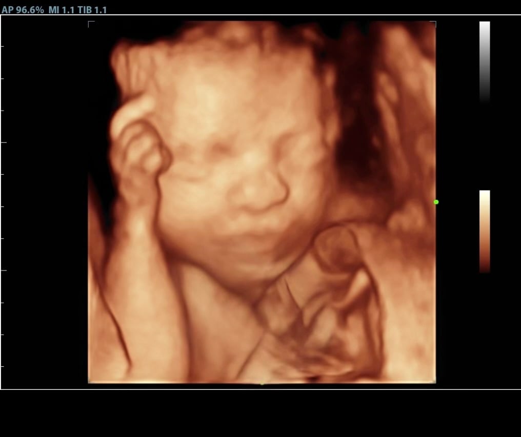 Ultrasound technology