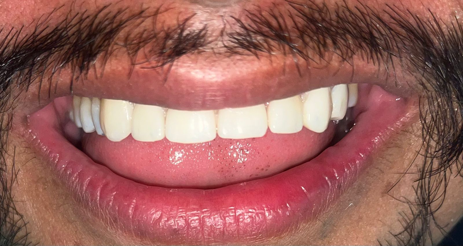 Después de tratamiento con carillas - sonrisa completa