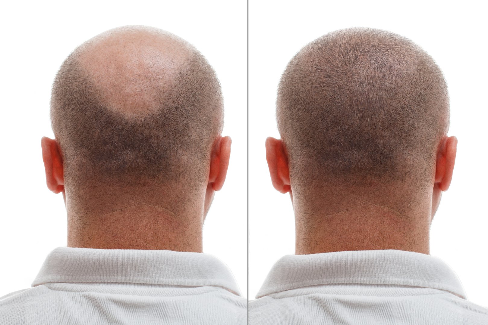 The head of a balding man before and after hair transplant surgery. A man losing his hair has become shaggy. An advertising poster for a hair transplant clinic. Treatment of baldness