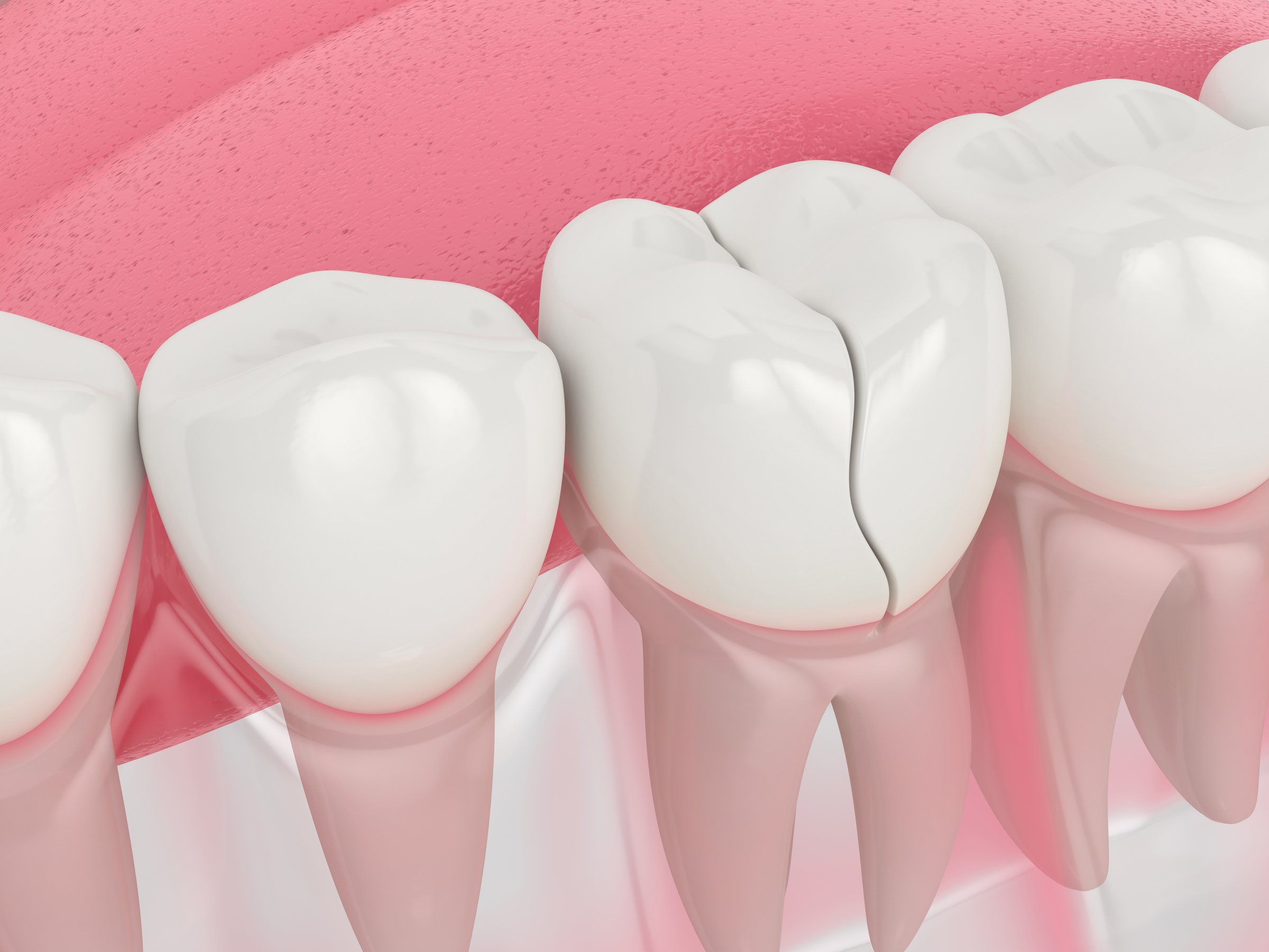 Close-up of a damaged dental crown