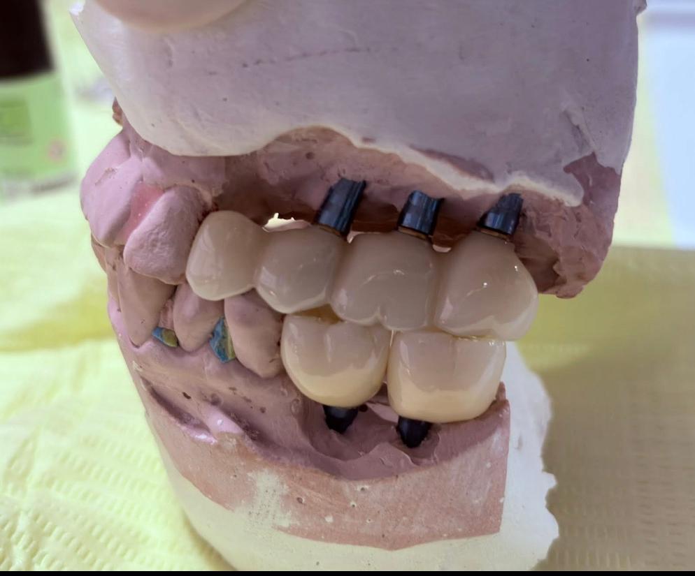 Fase de Rehabilitación sobre implantes dentales