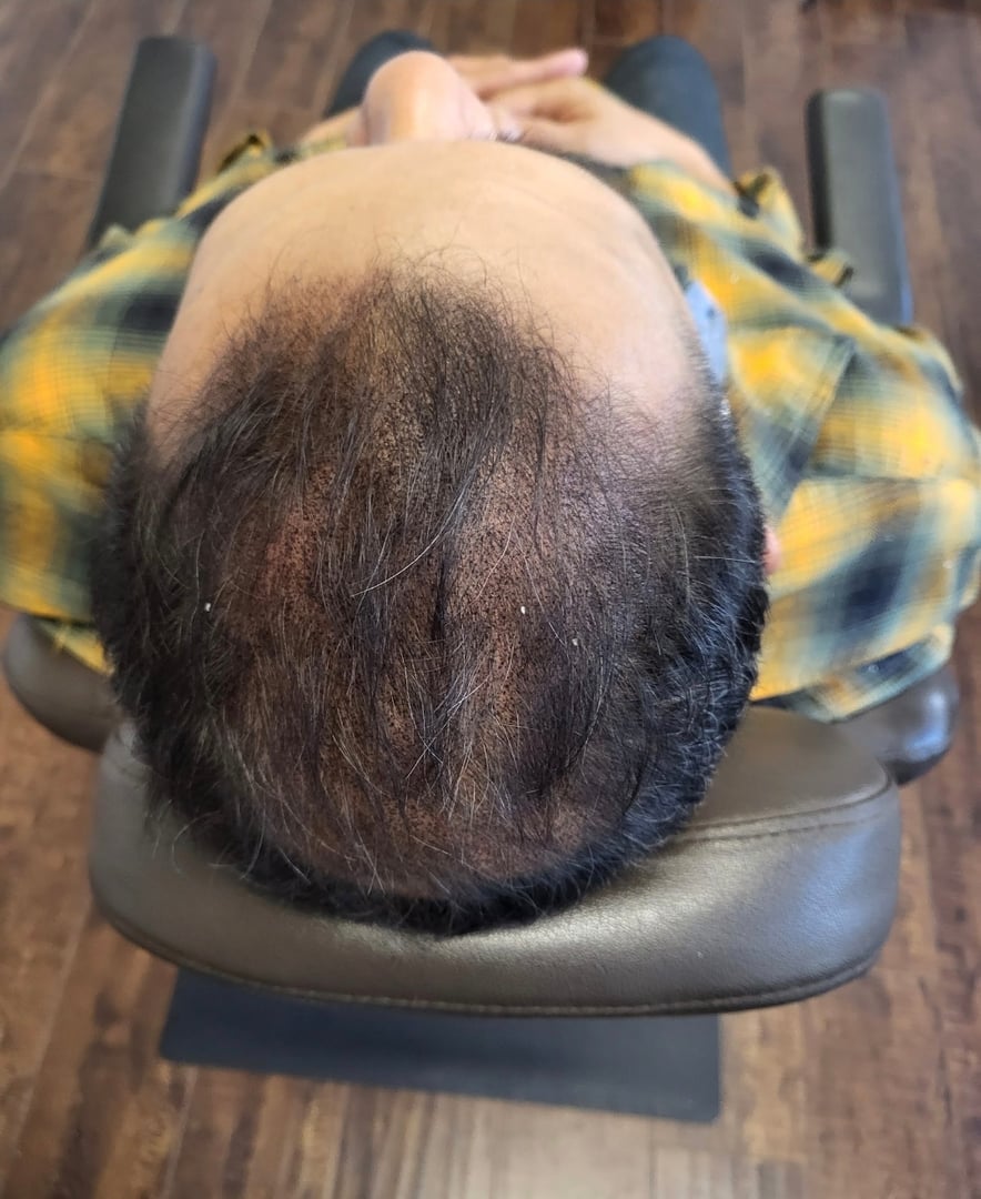 Before and After Scalp Micropigmentation Results - Real Client Transformation